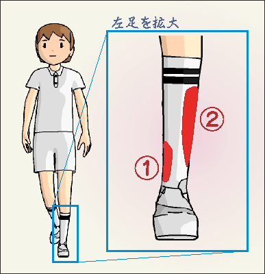 誰でもわかる シンスプリントについて みどり堂整骨院