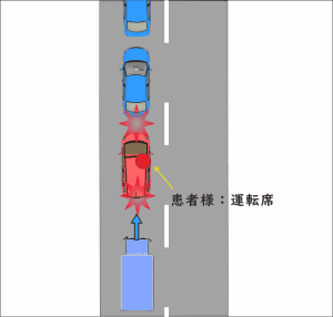 渋滞の最後尾で停車中に、後方からトラックに追突され、玉突き事故となった交通事故の図