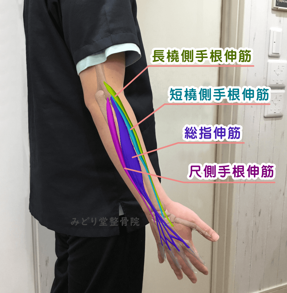 テニス肘に関与する筋肉を示す説明画像