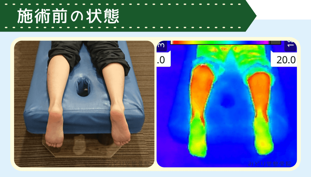 トルマリンホットパック施術前のふくらはぎとサーモグラフィー温度分布比較