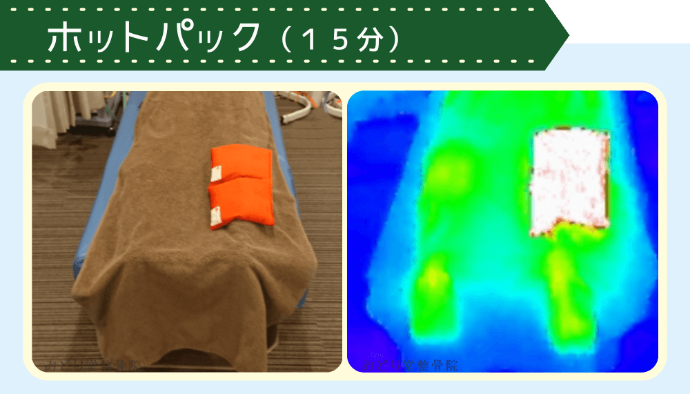 電気治療＋ホットパック施術中のサーモグラフィーによる温度確認