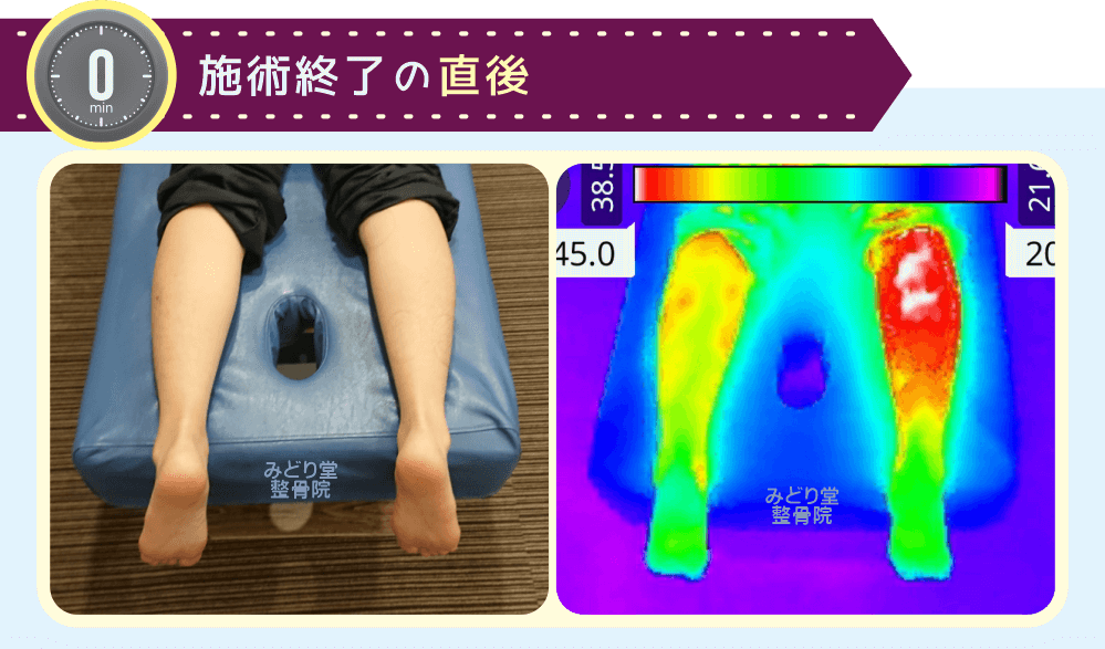 トルマリンホットパック施術直後の温度変化サーモグラフィー画像