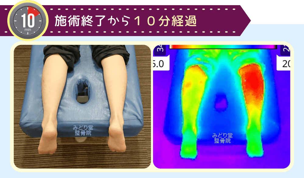 ホットパック施術終了10分後の温度持続確認画像