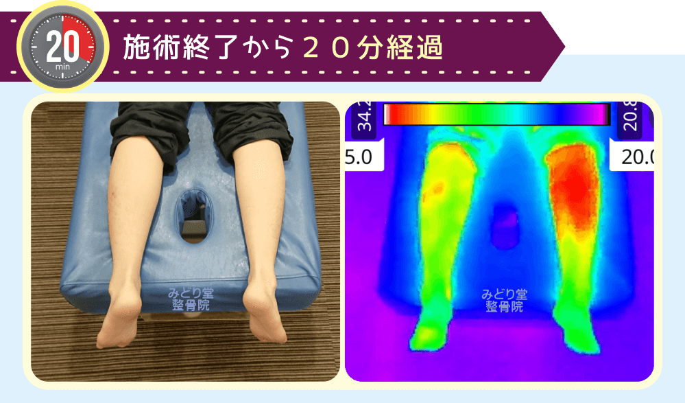 ホットパック施術終了20分後の温熱持続サーモグラフィー