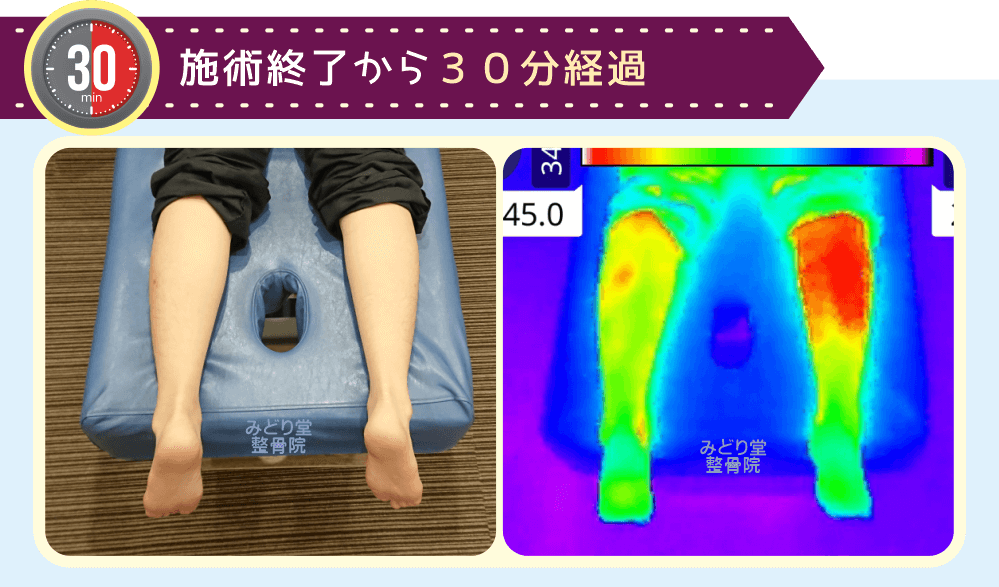 ホットパック施術終了30分後のふくらはぎ温度変化