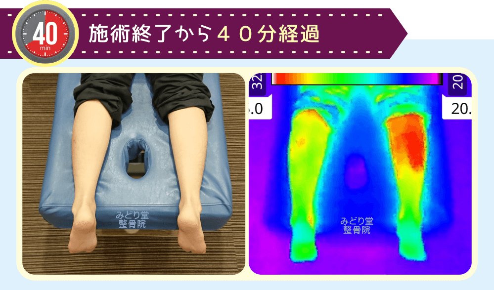 ホットパック施術終了40分後の左右温度比較