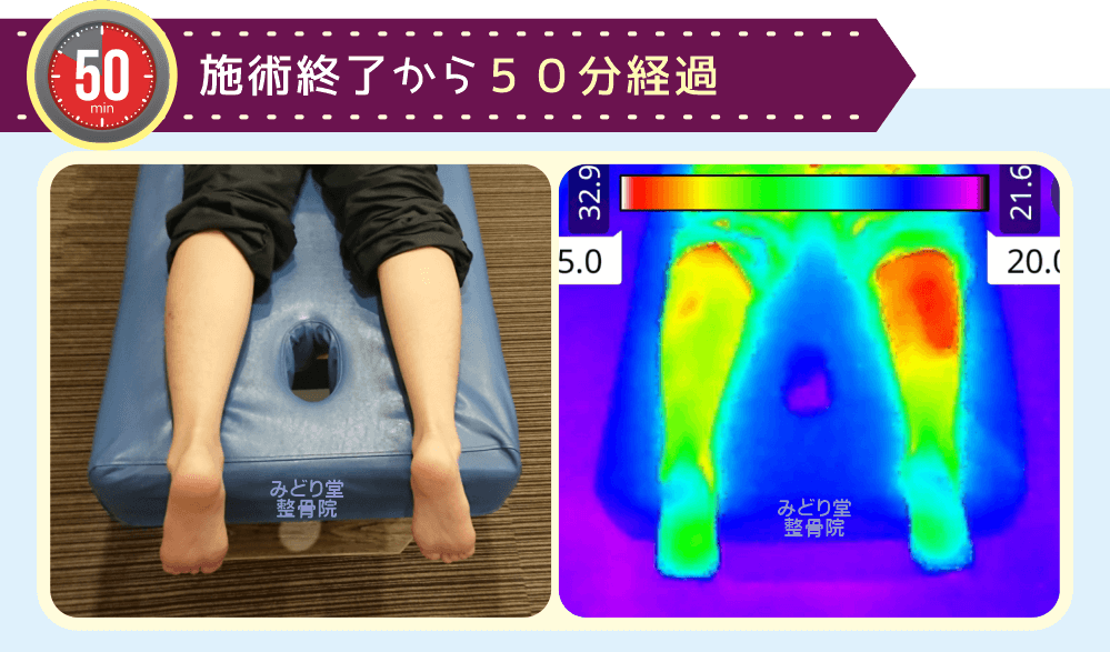 ホットパック施術終了50分後の温熱持続確認