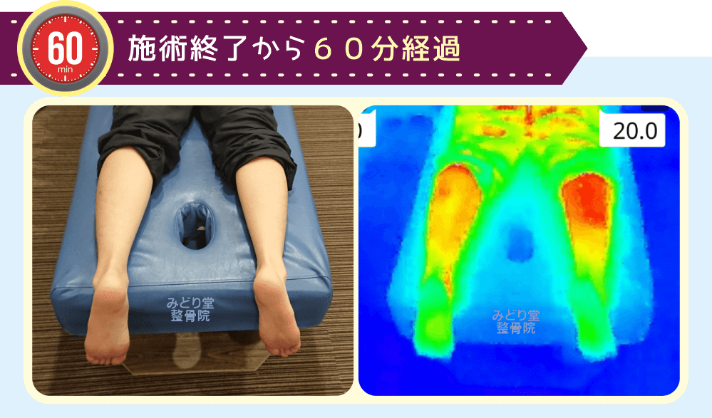ホットパック施術終了60分後の温度差検証結果