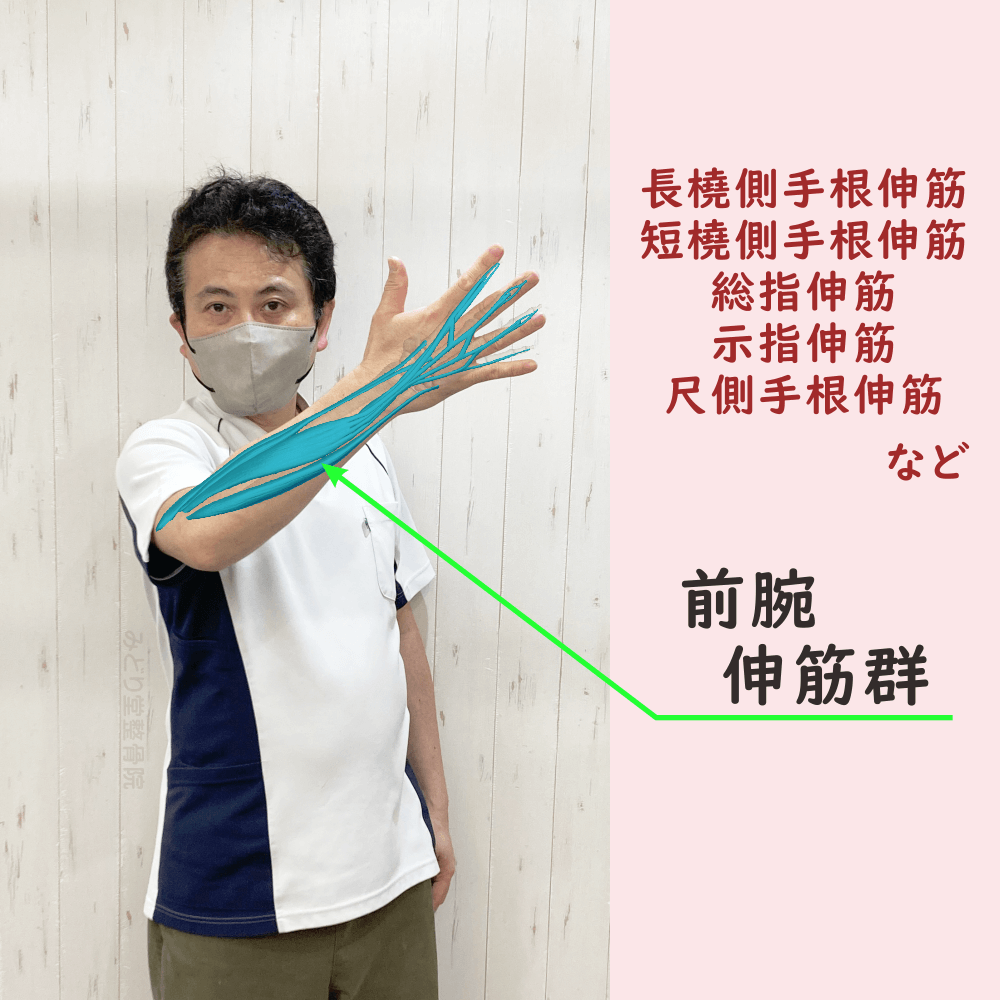 前腕伸筋群の位置をスタッフ写真に重ねて示した図解画像（モデル：院長・臼田）